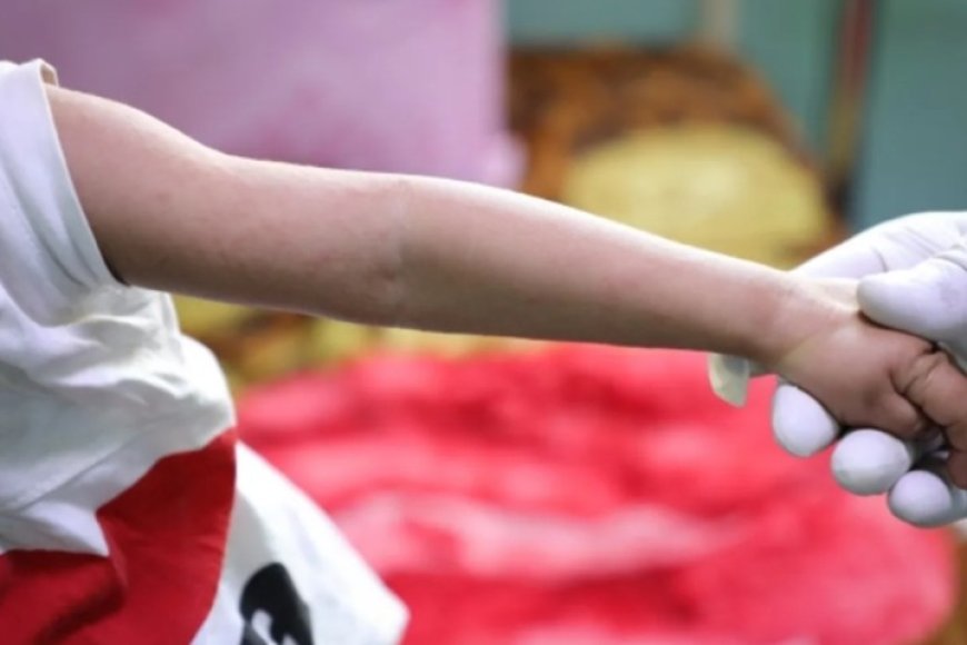 الإعلام الصحي في تعز يكشف عن وفيات وإصابات بفيروس الحصبة ...