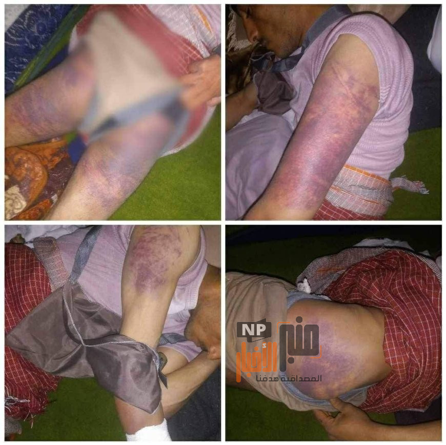 شاهد صور مرعبة.. شاب يتعرض لاعتداء وحشي من قيادي حوثي في صنعاء 
