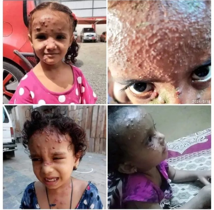الإرهاب الحوثي يقتل اطفال الحديدة..
