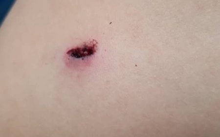 بسبب الرصاص الراجع.. إصابة طفل في صنعاء (صورة)