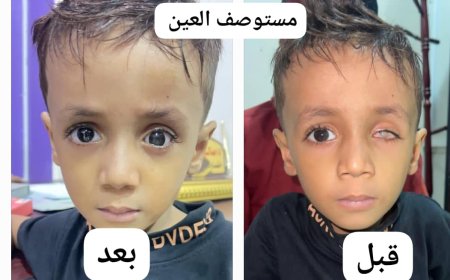 مستوصف العين التخصصي في عدن ينقذ طفلاً من التنمر بإجراء عملية تجميلية مجانية