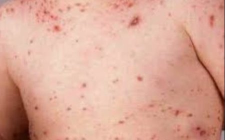 الصحة العالمية تعلن ارتفاع ضحايا مرض الحصبة في اليمن..