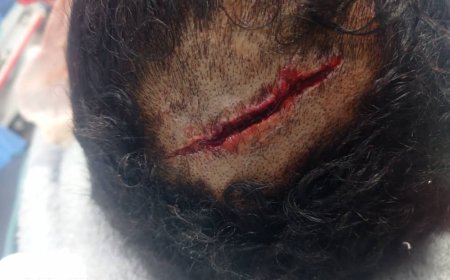 شاهد صورة.. إصابة بالغة يتعرض لها بائع قات في لحج (بسبب لا يصدق)