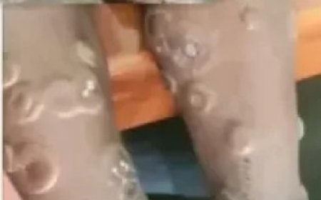 محافظة إب تسجيل أول حالة إصابة بجدري القرود..
