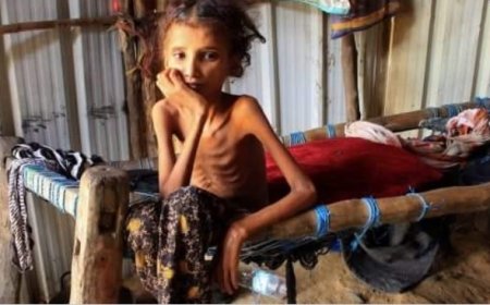 تقرير أممي يكشف عن حرمان  654 ألف طفل وامرأة من علاج سوء التغذية...
