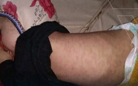 محافظة مأرب تسجل أكثر من 600 حالة اشتباه بالحصبة و10 وفيات..