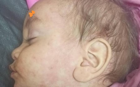 انتشار لمرض الحصبة بقرى المسيمير بلحج والأهالي يناشدون السلطات الصحية