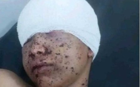 طفل يتيم يفقد عينه بقصف حو,,ثي مدفعي على حي مكتظ شمال مدينة تعز ...