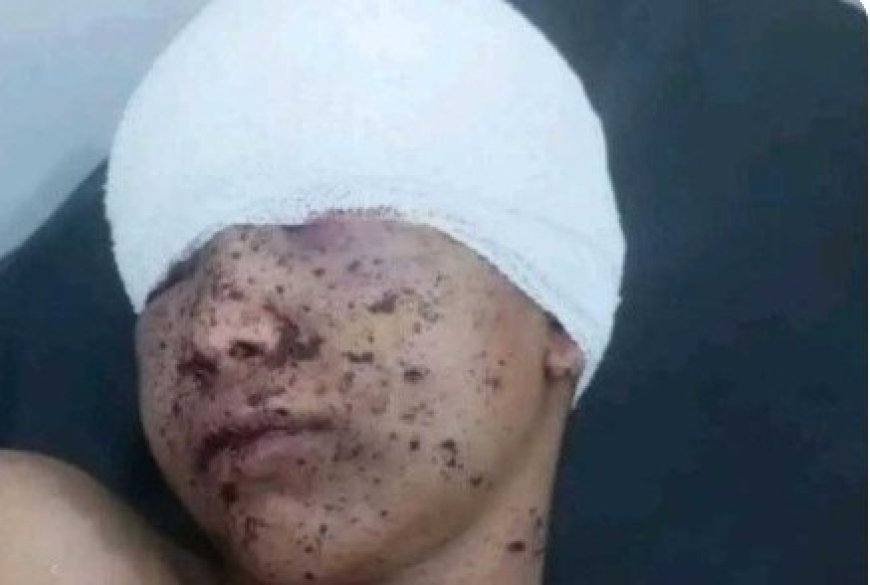 طفل يتيم يفقد عينه بقصف حو,,ثي مدفعي على حي مكتظ شمال مدينة تعز ...