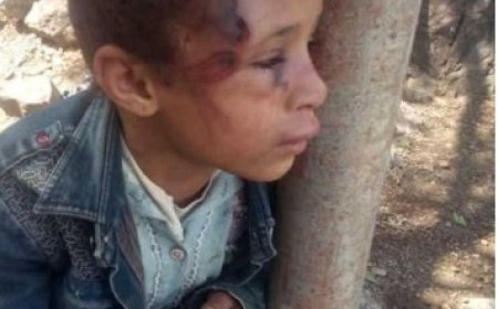 طفلة في تعز تتعرض لاعتداء جسدي مروع ..