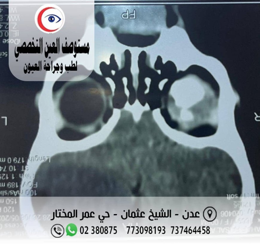 قرار طبي صعب ينقذ حياة طفل في مستوصف العين التخصصي بعدن