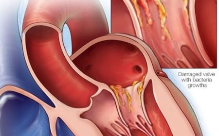 تحذير طبي من انتشار التهاب شغاف القلب في الضالع...