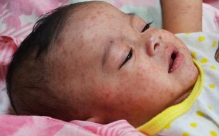 تفشي الحصبة يودي بحياة أكثر من 100 طفل في اليمن.....