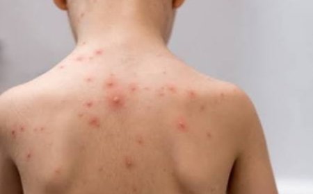 صنعاء تواجه تفشي جدري الماء وشلل الأطفال بين الأطفال.....